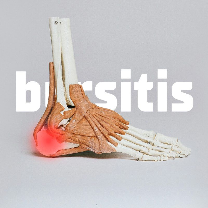 Bursitis Calcánea